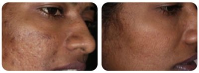 Microneedling (Cheeks) 